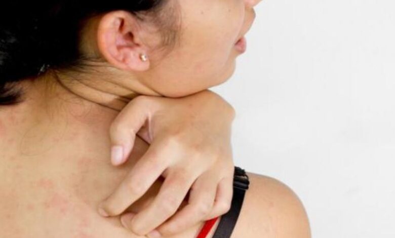 Penderita penyakit gula juga juga obesitas rentan terkena jamur di dalam di epidermis